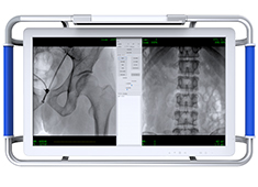 C臂机的图像质量越用越差? 原因可能是球管的衰减