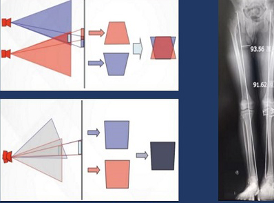 拍摄全脊柱X光片 长骨拼接技术和一板成像的区别