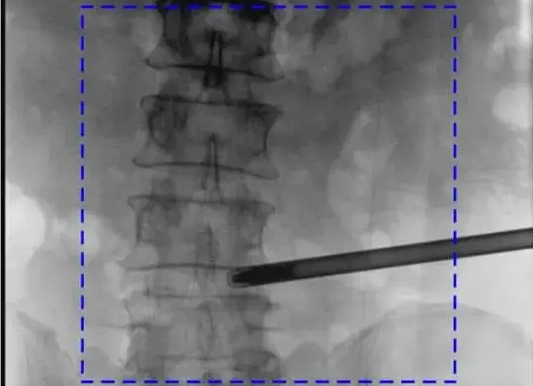 C臂机图像不清楚的常见原因及解决办法