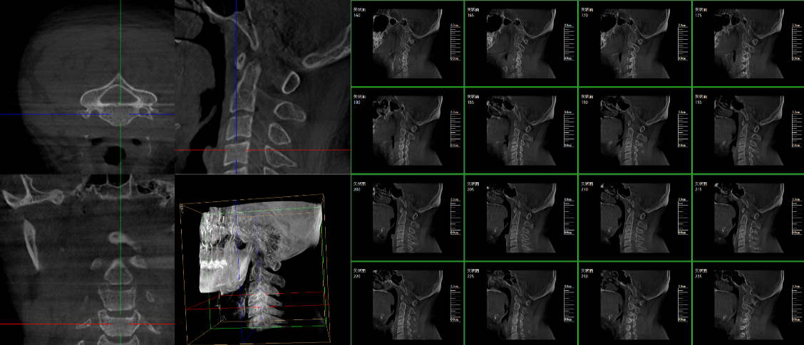 三维C形臂成像 三维C形臂成像