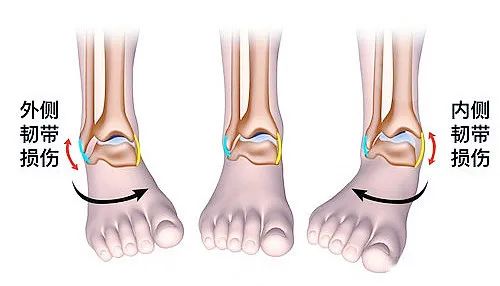 【医疗科普】之为什么说踝关节骨折手术复杂？