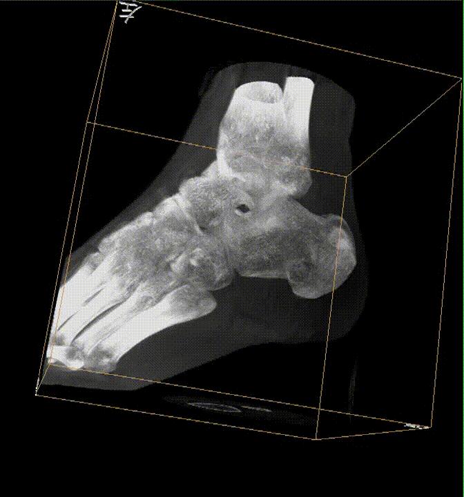 【医疗科普】之为什么说踝关节骨折手术复杂？