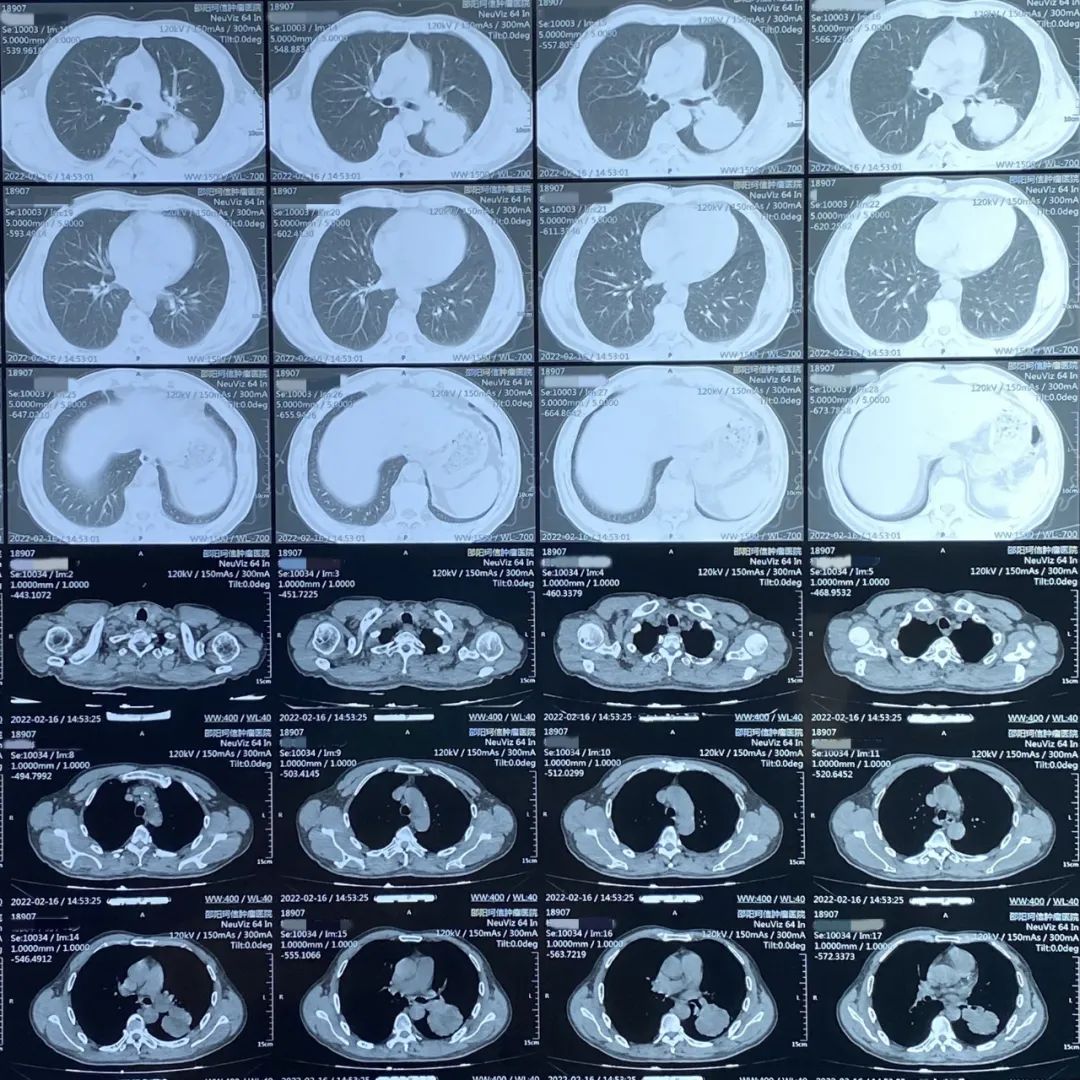 肺部CT诊断 肺部CT诊断