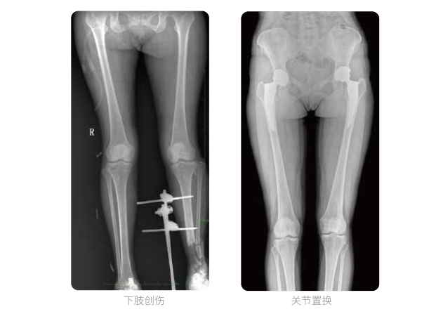 动态DR的双下肢临床影像 动态DR的双下肢临床影像