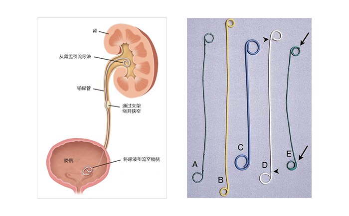 输尿管支架工作原理及常见的双J管 输尿管支架工作原理及常见的双J管