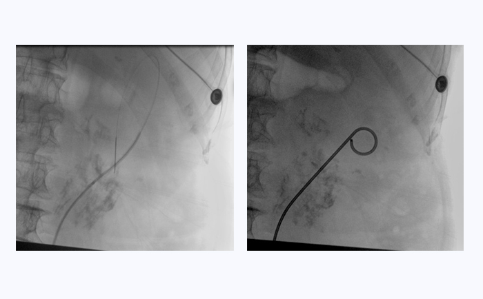 大平板一体式C形臂临床图像 大平板一体式C形臂临床图像