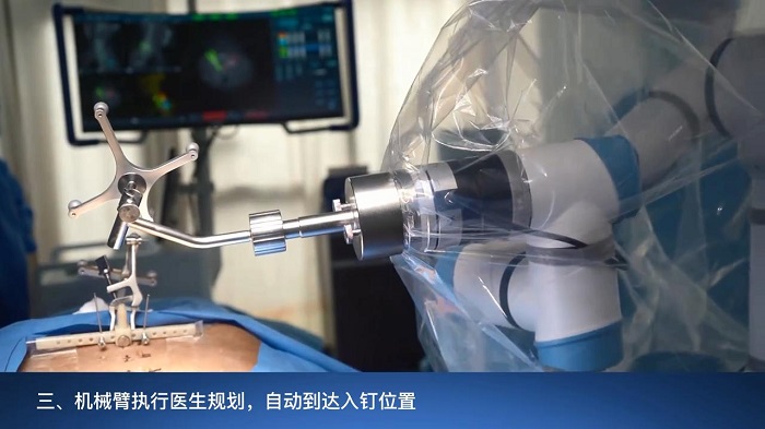 骨科手术机器人和医生分工3