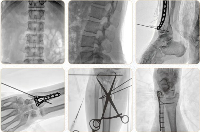  移动式平板C形臂