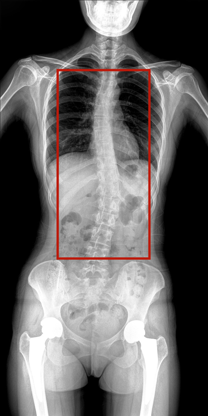 全脊柱动态DR图像 全脊柱动态DR图像