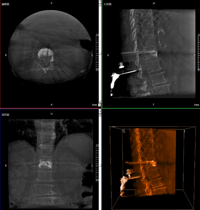 骨科机器人影像