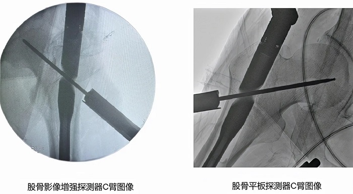 影增C臂和平板C臂图像对比