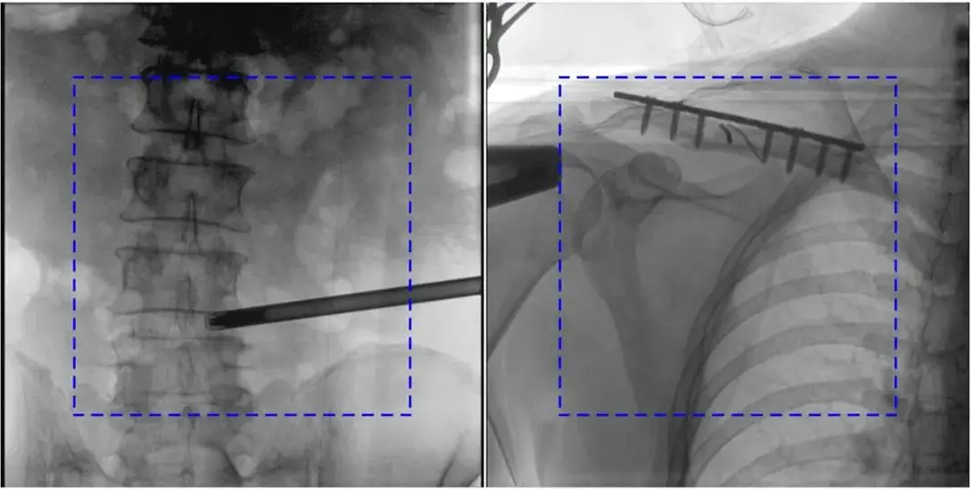 C臂机图像不清楚